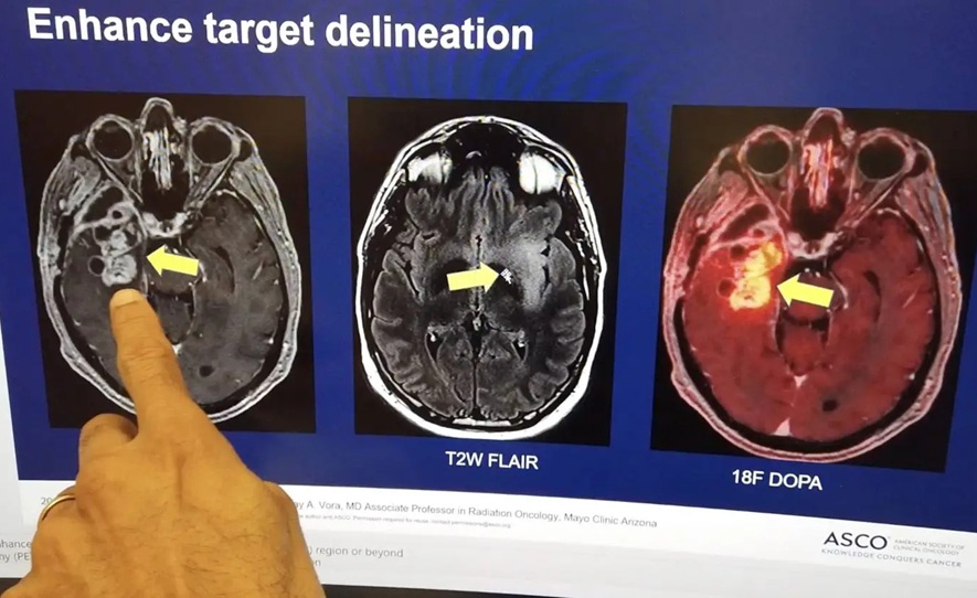 Imagen: La combinación de imágenes avanzadas permitió a los investigadores determinar las regiones metabólicamente más activas o agresivas del glioblastoma (Foto cortesía de Mayo Clinic)