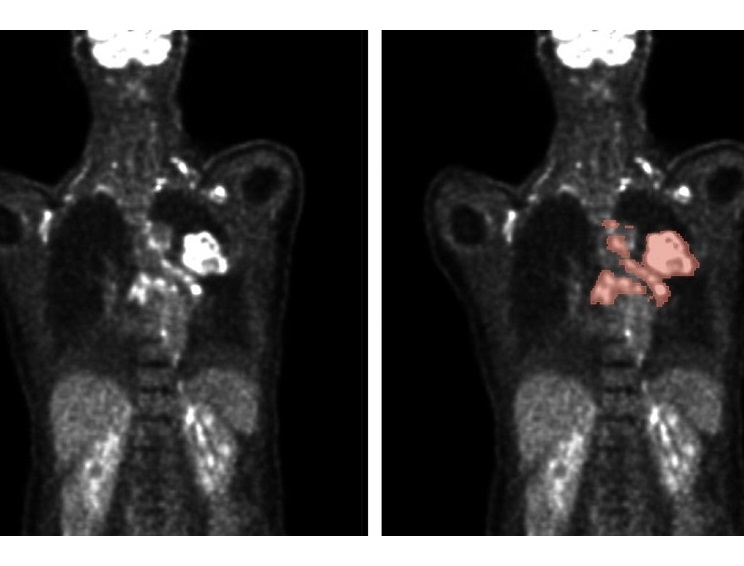 Imagen: Los métodos automatizados permiten el análisis de exploraciones PET/CT (izquierda) para predecir con precisión la ubicación y el tamaño del tumor (derecha)(Foto cortesía de Nature Machine Intelligence, 2024. DOI: 10.1038/S42256-024-00912-9)