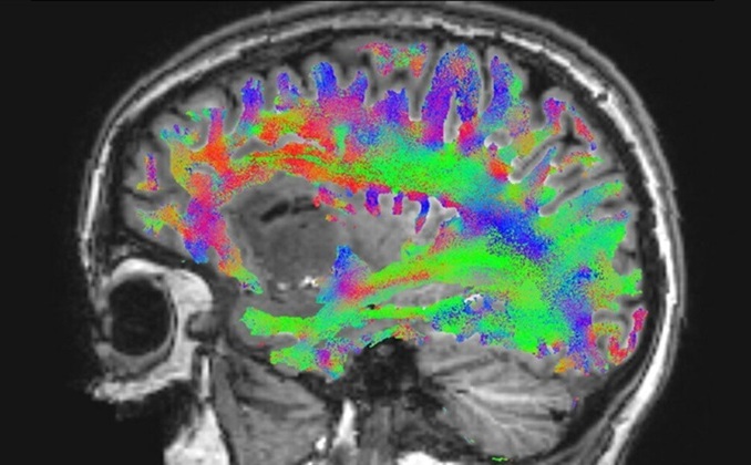 Imagen: Conexiones de la materia blanca mapeadas en la imagen de resonancia magnética del glioma de un paciente (Foto cortesía de Lars Smolders/TU/e)