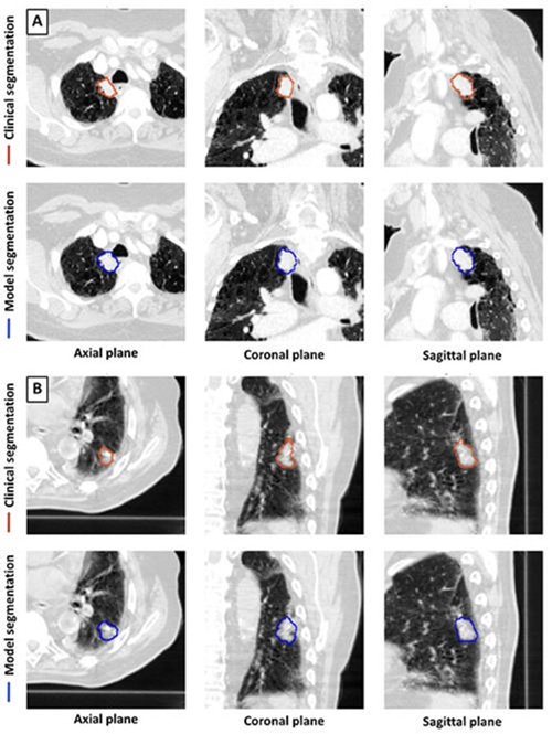 Imagen: Ejemplos de segmentación clínica y de modelos (Foto cortesía de Radiology, DOI:10.1148/radiol.233029)