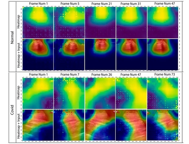 Imagen: Mapas de calor que la IA evaluó para realizar diagnósticos de enfermedades pulmonares (Foto cortesía de COVIDx-US)