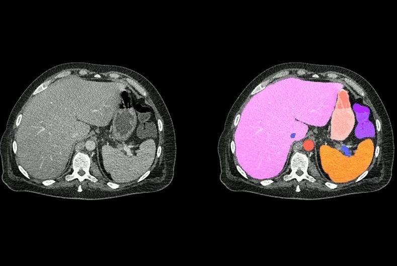 Imagen: Dos cortes de TC abdominal, estándar a la izquierda y segmentación de órganos de AbdomenAtlas a la derecha (Foto cortesía de la Universidad Johns Hopkins)