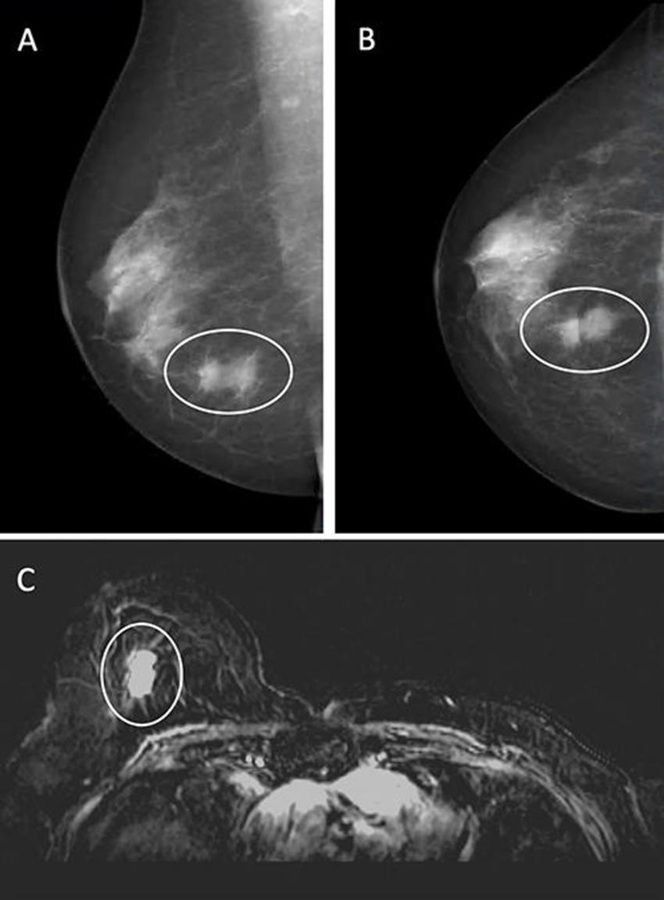 Imágenes de una mujer de 67 años con antecedentes de cáncer de mama que se sometió a una mamografía combinada y una resonancia magnética (Foto cortesía de Radiology, DOI:10.1148/radiol.233067)