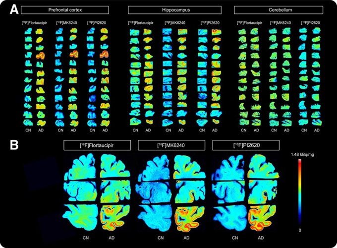 Imágenes de autorradiografía que muestran la unión de [18F]flortaucipir, [18F]MK6240 y [18F]PI2620 en la corteza prefrontal, el hipocampo y el cerebelo (A) y en todo el hemisferio cerebral (B) de cerebros de control y con EA (Foto cortesía de UFRGS)