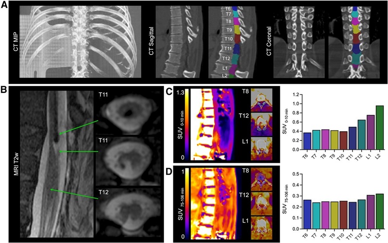 Imagen: [18F]3F4AP en un sujeto humano después de una lesión medular leve e incompleta (foto cortesía de The Journal of Nuclear Medicine, DOI:10.2967/jnumed.124.268242)