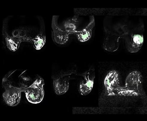 Imagen: Imágenes de resonancia magnética que muestran cómo el tejido canceroso puede brillar en imágenes de color verde claro (Foto cortesía de la Universidad de Waterloo)