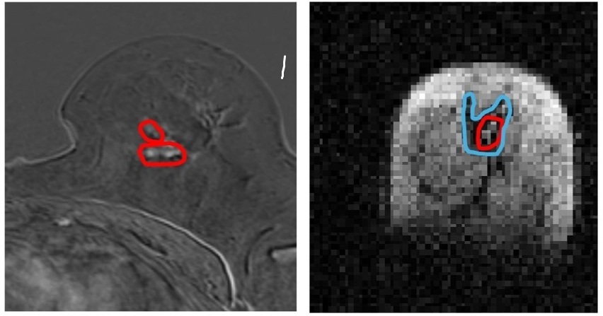 Imagen lado a lado del mismo tejido mamario en RM y FCI (foto cortesía de la Universidad de Aberdeen)