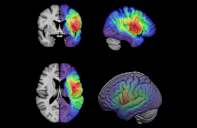 Imagen: muestras compuestas de imágenes de resonancia magnética que AStrID utilizará para avanzar en la investigación que promete optimizar la rehabilitación de los accidentes cerebrovasculares (foto cortesía de la Facultad de Medicina de GU)