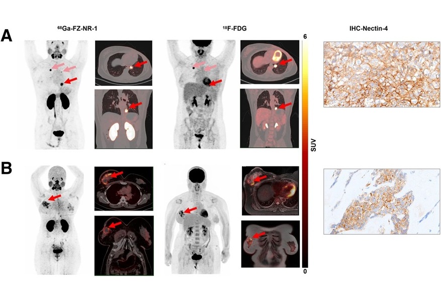 Imágenes PET/TC con 68Ga-FZ-NR-1 e imágenes PET/TC y PET/RM con 18F-FDG en pacientes representativos con TNBC con nectina-4 positiva (foto cortesía del Journal of Nuclear Medicine)