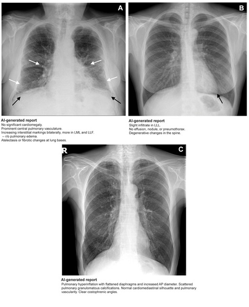 Imagen: Ejemplos de interpretaciones de radiografías de tórax con y sin informes generados por IA (foto cortesía de Radiology, DOI: 10.1148/radiol.241646)