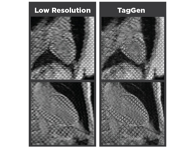 Imagen: una infografía que compara imágenes de resonancia magnética de baja resolución con imágenes mejoradas por el modelo TagGen (foto cortesía de Claudia Carver/MU Health Care)