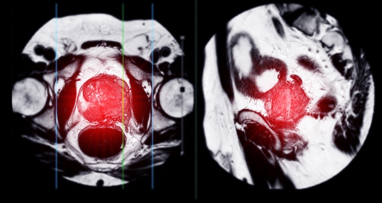 Imagen: Los investigadores han lanzado un ensayo internacional para probar si la IA puede igualar a los radiólogos expertos en la detección de enfermedades clínicamente significativas en la resonancia magnética (Crédito de la imagen: iStock)