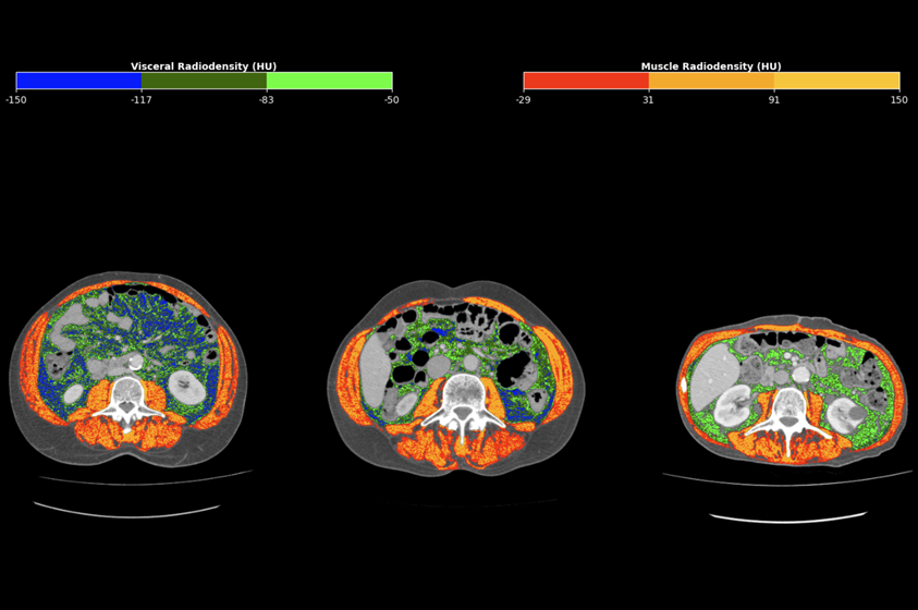 Imagen: El estudio desarrolló un marcador basado en el análisis de tomografías computarizadas de rutina de pacientes con cáncer gástrico tratados en la Unicamp. Los valores más altos de radiodensidad del tejido adiposo están relacionados con un peor pronóstico. Por el contrario, valores más altos de músculo están relacionados con un resultado más favorable (Fotografía cortesía de FCM-UNICAMP)