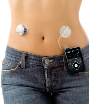 The MiniMed 640G insulin pump with built-in continuous glucose monitoring