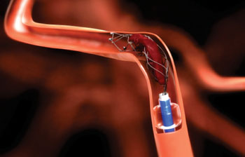 The Solitaire FR revascularization device