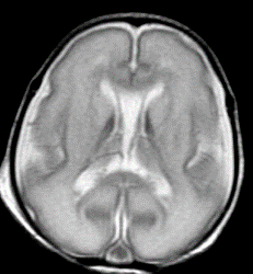 Image:  Anatomy (MRI) of the brain—15 weeks premature (Photo courtesy of RSNA).