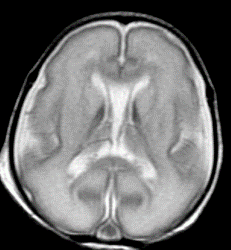 Структура (МРТ) головного мозга недоношенного на 15 недель ребенка (фото любезно предоставлено RSNA).