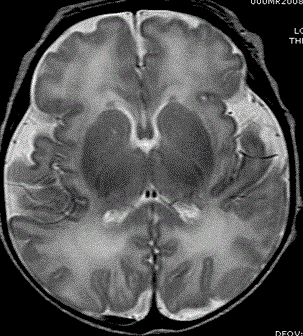 Структура (МРТ) головного мозга доношенного ребенка (фото любезно предоставлено RSNA).