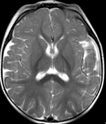 Структура (МРТ) головного мозга годовалого ребенка (фото любезно предоставлено RSNA).