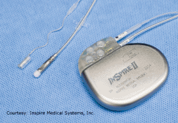 Image: The Inspire UAS device (Photo courtesy of Inspire Medical Systems).