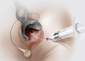 Image: The Biodesign anal fistula plug being drawn through the fistula (Photo courtesy Cook Medical).