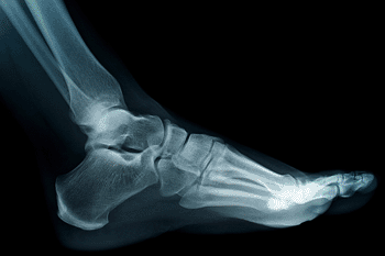 *Plating System Aids Foot and Hand Treatment Image: The CrossCheck plating system, designed for use in ankle and foot procedures to enhance the fatigue strength, and improve stabilization (Photo courtesy of Solana Surgical). *Plating System Aids Foot and Hand Treatment Image: The CrossCheck plating system, designed for use in ankle and foot procedures to enhance the fatigue strength, and improve stabilization (Photo courtesy of Solana Surgical).