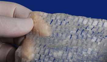 Image: The MatriStem Multilayer Wound Matrix device is designed for deep, hard-to-heal wounds (Photo courtesy of ACell).