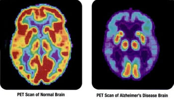 Image: PET scans showing the differences between a normal older adult\'s brain and the brain of an older adult afflicted with Alzheimer\'s disease (Photo courtesy of the NIH). Image: PET scans showing the differences between a normal older adult\'s brain and the brain of an older adult afflicted with Alzheimer\'s disease (Photo courtesy of the NIH).