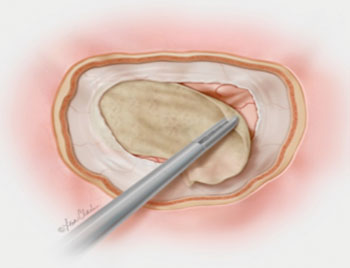Image: The Biodesign Duraplasty Graft in situ (Photo courtesy of Cook Medical).