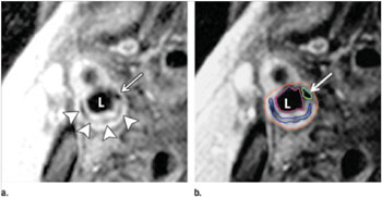 Image: Transverse gadolinium-enhanced T1-weighted MR images obtained superior to the carotid artery bifurcation in a 72-year-old man. L = ICA (internal carotid artery) lumen. (a) Low-signal-intensity calcium (arrow) and lipid core (arrowheads) can be seen. (b) Note contouring of the ICA. The outer adventitial wall (red), lipid core (blue), calcification (green), and vessel lumen (purple) are visible (Photo courtesy of the Radiological Society of North America).