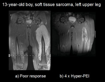 Image: Undifferentiated soft tissue sarcoma of the left upper leg in a 13-year old boy. On the left, insufficient tumor response after standard chemotherapy therapy. On the right, follow-up after four thermochemotherapy courses according to the Hyper-PEI protocol. The residual tumor mass could be completely resected without mutilation. (Photo courtesy of Heinrich-Heine-University)