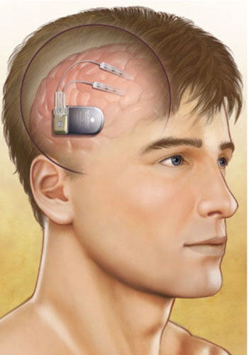 Image: The NeuroPace RNS System in situ (Photo courtesy of NeuroPace).