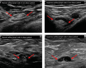 Image: Ultrasound imaging used to identify breast cancer in underarm lymph nodes in obese women has generated an unexpected finding: Fat did not obscure the images, and ultrasound imaging showing no suspicious lymph nodes actually was shown to be more accurate in overweight and obese patients than in women with a normal body mass index (Photo courtesy of the Mayo Clinic). Image: Ultrasound imaging used to identify breast cancer in underarm lymph nodes in obese women has generated an unexpected finding: Fat did not obscure the images, and ultrasound imaging showing no suspicious lymph nodes actually was shown to be more accurate in overweight and obese patients than in women with a normal body mass index (Photo courtesy of the Mayo Clinic).