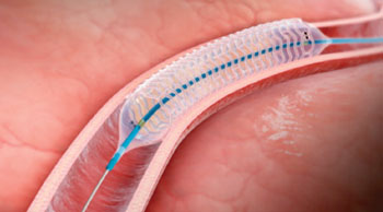 Image: The DESolve 100 Coronary Scaffold System (Photo courtesy of Elixir Medical).