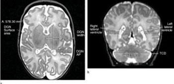 Image: (a) Axial T2-weighted image shows deep gray nuclei (DGN) width, anteroposterior (AP) distance, and surface area. (b) Coronal T2- weighted image shows lateral ventricle atrial measures and transverse cerebellar diameter (TCD) (Photo courtesy of the Radiological Society of North America).