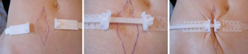 Image: The TopClosure System (Photo courtesy of IVT Medical).