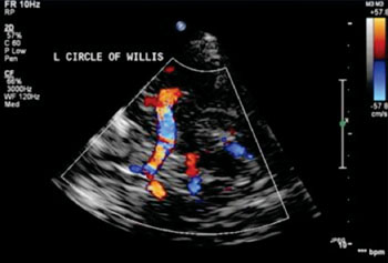 Image: Ultrasound image of the Circle of Willis (Photo courtesy of the Swedish Cerebrovascular Center, Seattle, WA, USA).