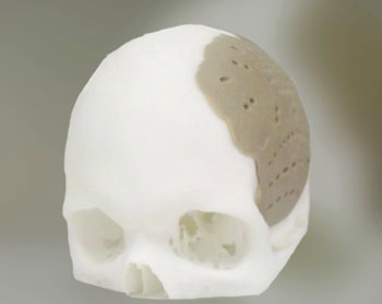 Image: An OPSFD implant designed to reconstruct part of the cranium (Photo courtesy of OPM).