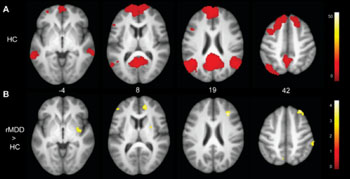 Image: Connectivity of left posterior cingulate seed and between group differences. Panel A: Connectivities among HC youth illustrate the default mode network. Panel B: Youth with remitted depression demonstrated greater connectivity with the right insula, superior and middle frontal gyrus, putamen, angular gyrus, and left middle frontal gyrus (Photo courtesy of Plos One journal).
