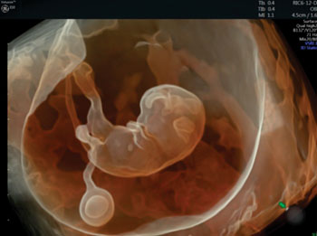 Image: Although clinically important, parents-to-be can be dismayed with the blurry gray image that appears with the first scan of their baby. This colored 3D image was captured using the Voluson E10 ultrasound system (Photo courtesy of GE healthcare).