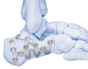 Image: The DePuy Synthes Trauma VA LCP system (Photo courtesy of DePuy Synthes).