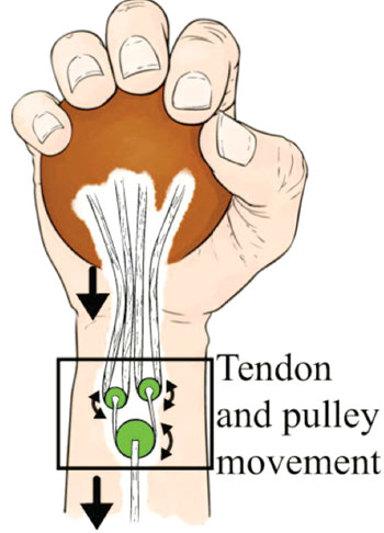 Image: Schematic of the implanted pulley system to improve grasping function (Photo courtesy of Oregon State University).