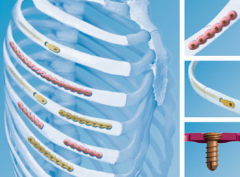 Image: The MatrixRib plate osteosynthesis fixation system (Photo courtesy of DePuy Synthes).