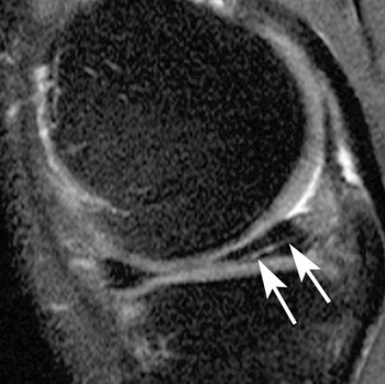 Image: Examples of meniscal tears and status after surgery. Sagittal intermediate-weighted fat-saturated image shows a typical horizontal-oblique meniscal tear of the posterior horn reaching the undersurface of the meniscus (arrows) (Photo courtesy of RSNA).