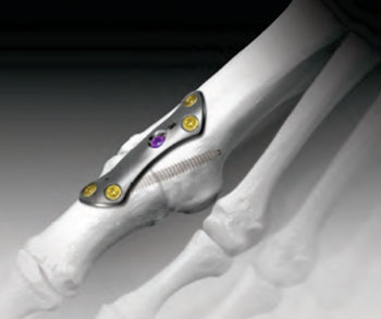 Image: The CrossCHECK MTP compression plate in-situ (Photo courtesy of Solana Surgical).