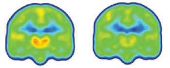 Image: Created by averaging PET scan data from chronic pain patients (left) and healthy controls (right), the images reveal higher levels of inflammation-associated translocator protein (orange/red) in the thalamus and other brain regions of chronic pain patients (Photo courtesy of Marco Loggia, Martinos Center for Biomedical Imaging, Massachusetts General Hospital).