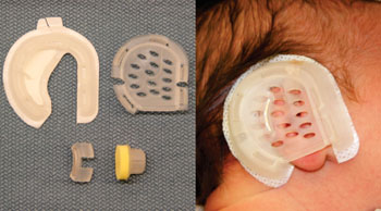 Image: The EarWell Infant Ear Correction System (Photo courtesy of Dr. Melissa Doft/ NYP).