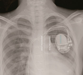 Image: Comparative sizes of fetal and adult pacemakers (Photo courtesy of Children’s Hospital Los Angeles).