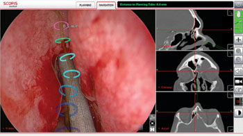 Image: The Scopis Target Guided Surgery (TGS) system (Photo courtesy of Scopis Medical).