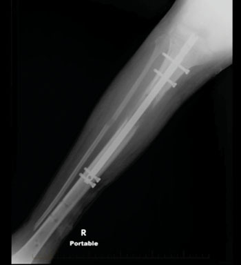 Image: Implanted titanium intramedullary nail fixator (Photo courtesy of Loyola University Medical Center).